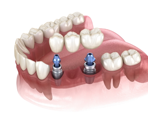 Genuine Family Dentistry | Restorative Dentistry, Cosmetic Dentistry and Dental Implants
