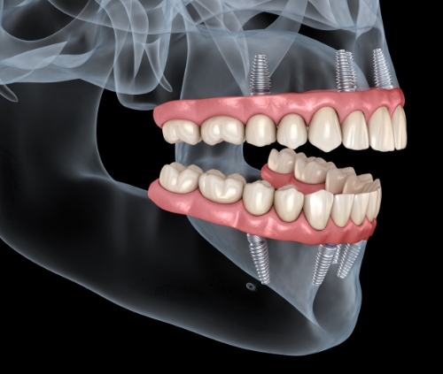 Genuine Family Dentistry | All On Four, Cosmetic Dentistry and Invisalign  