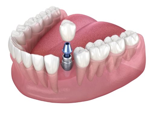 Genuine Family Dentistry | Periodontal Therapy, Cosmetic Dentistry and All On Four