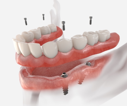 Genuine Family Dentistry | Dental Implants