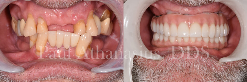 Genuine Family Dentistry | Full Mouth Reconstruction, Crowns and LANAP reg 