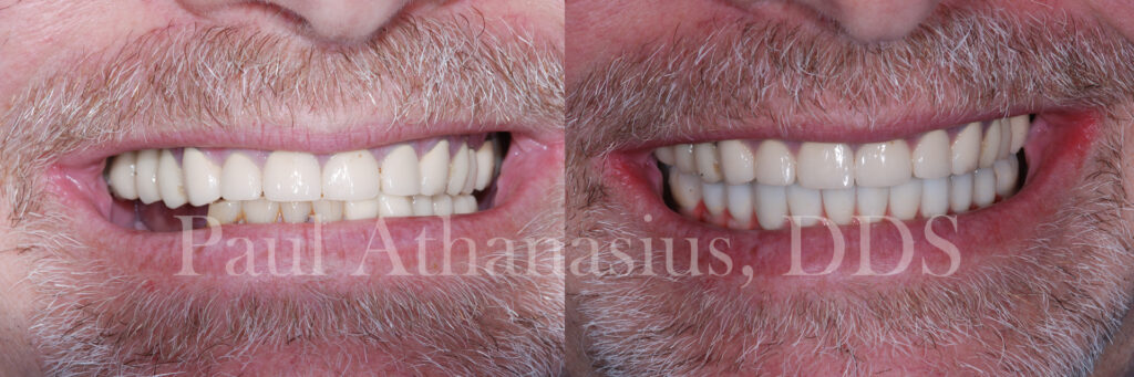 Genuine Family Dentistry | Ceramic Crowns, All-on-4® and Oral Exams