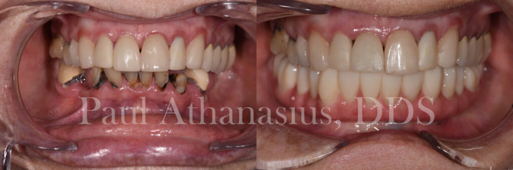 Genuine Family Dentistry | Veneers, Dentures and All-on-4®