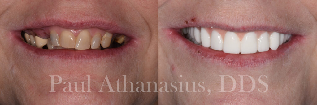 Genuine Family Dentistry | Invisalign®, Implant Restorations and ClearCorrect®