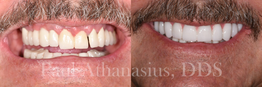 Genuine Family Dentistry | Dental Sealants, Implant Restorations and Extractions