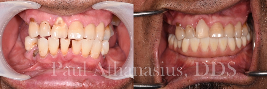 Genuine Family Dentistry | Full Mouth Reconstruction, Intraoral Camera and ZOOM  Whitening