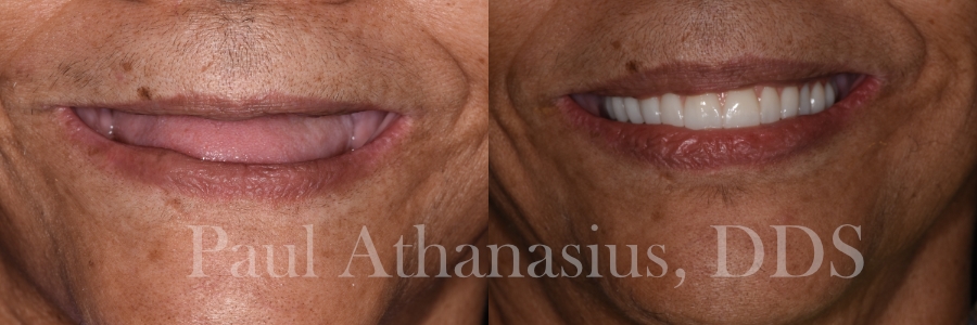 Genuine Family Dentistry | Juvederm reg , Dental Fillings and Root Canals